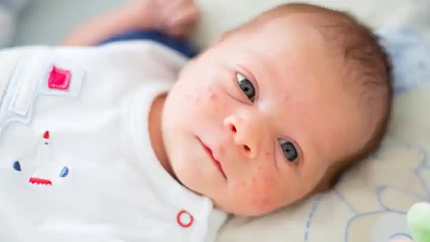 Bebeklerde Kafada İltihaplı Sivilce Nedenleri Belirtileri ve Uygun Bakım Yöntemleri