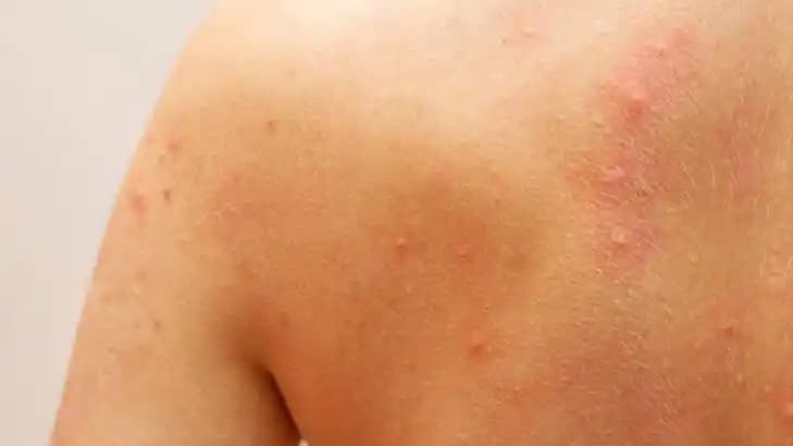 Bebeklerde Kaşıntı ve Kabarcıkların Nedenleri, Belirtileri ve Güvenli Tedavi Yöntemleri