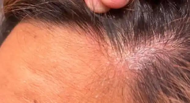 Bebeklerde Saç Diplerindeki Sarı Kabuklanmanın Nedenleri ve Uygun Bakım Yöntemleri