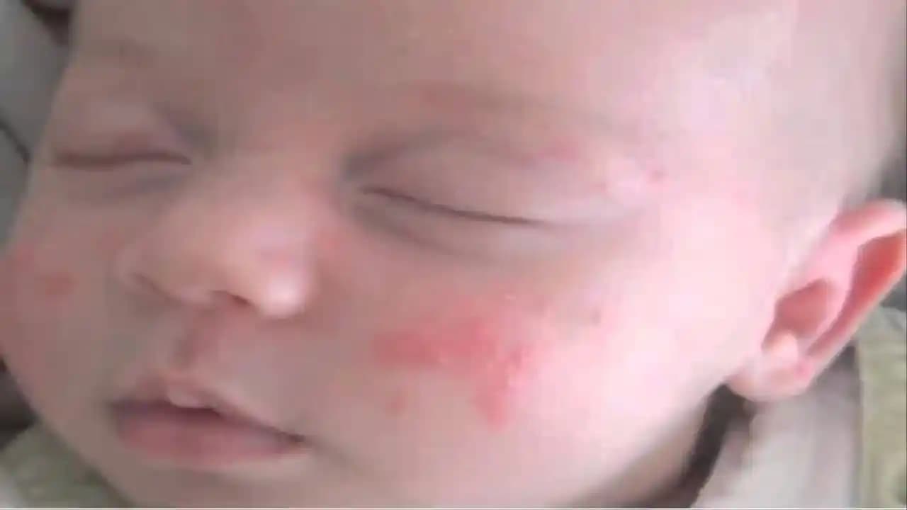 Bebeklerde Sivilce ve Kızarıklıkların Nedenleri, Belirtileri ve Güvenli Bakım Yöntemleri