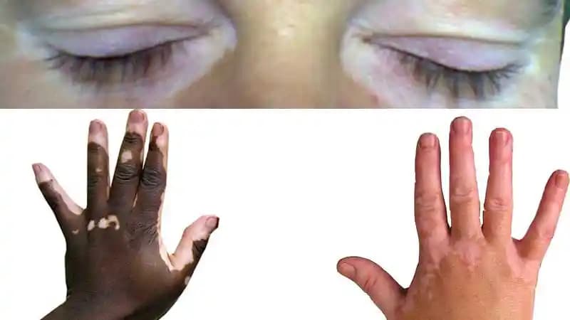 Bebeklerde Vitiligo Nedir, Belirtileri ve Etkili Tedavi Seçenekleri Hakkında Bilgiler