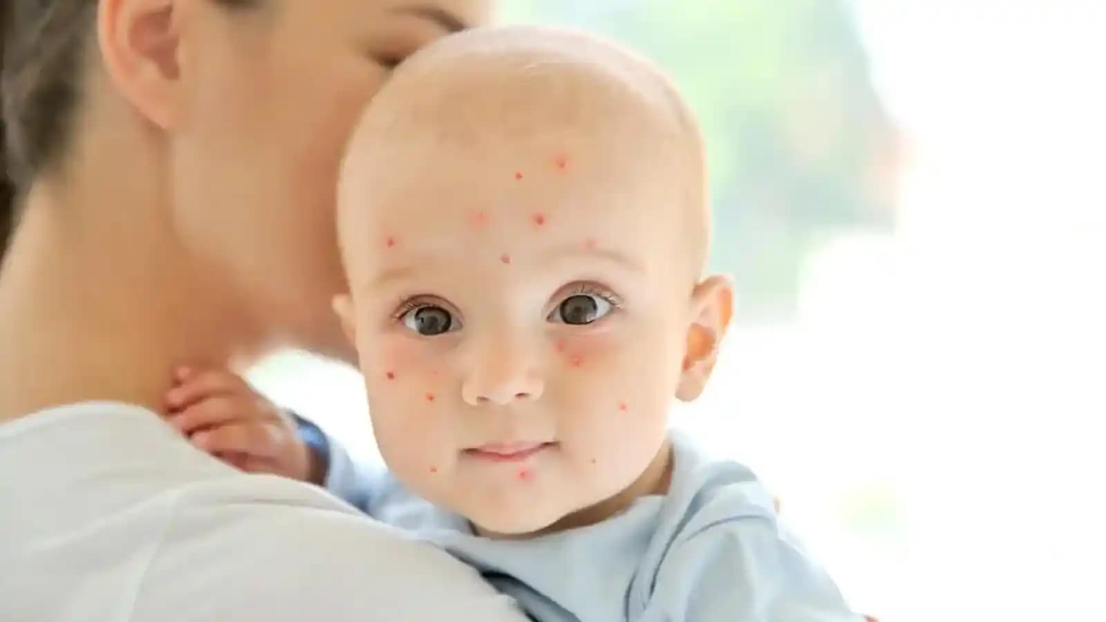 Bebeklerde Yanakta Sivilce Nedenleri, Tedavi Yöntemleri ve Dikkat Edilmesi Gerekenler