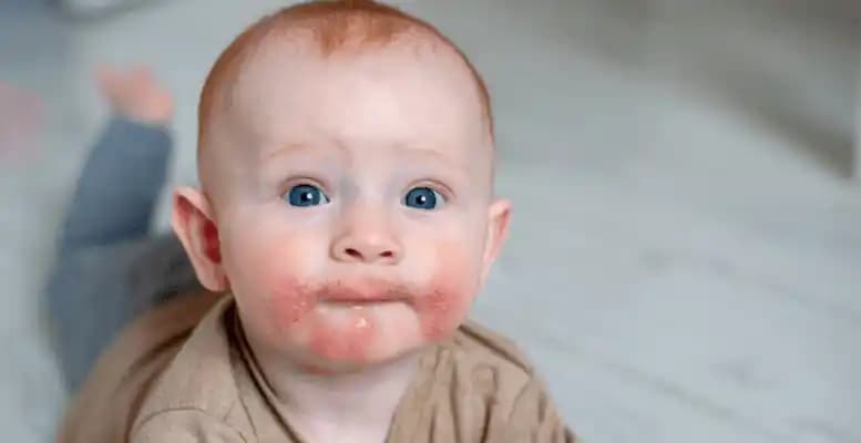 Bebeklerde Yüzde Kızarıklık ve Kuruluk: Doğru Bakım ve Önlemler Rehberi