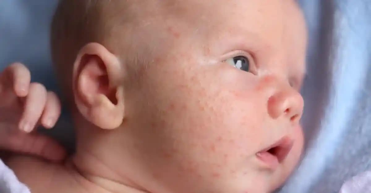 Bebeklerin Yüzünde Çıkan Sivilcelerin Nedenleri, Özellikleri ve Doğru Bakım Yöntemleri