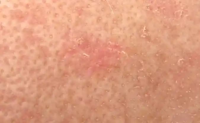 Burnun Üstündeki Kırmızı Leke Nedenleri, Belirtileri ve Çözüm Yolları Hakkında Bilmeniz Gerekenler