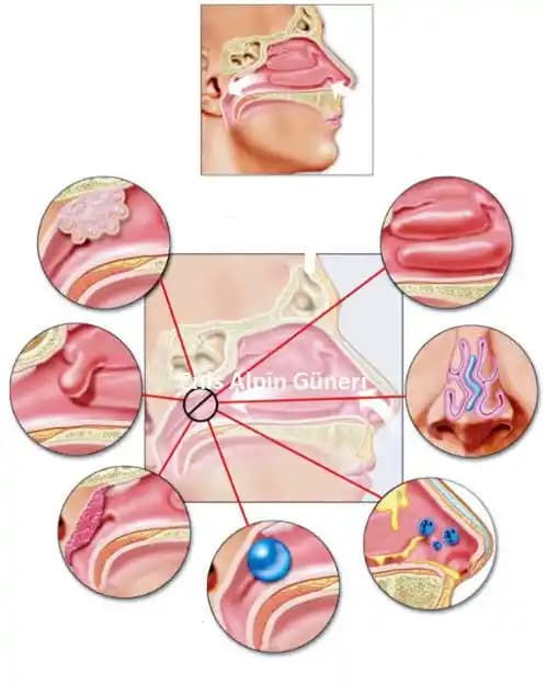 Burun İçinde İltihap: Belirtileri, Nedenleri ve Kozmetik Etkileri Hakkında Kapsamlı Bilgi