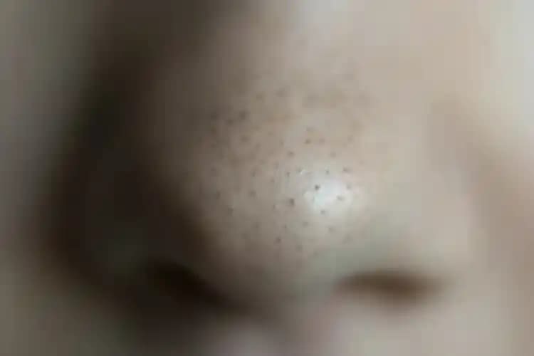 Burun Üstündeki Geniş Gözenekleri Azaltma Yöntemleri ve Cilt Sağlığı İpuçları