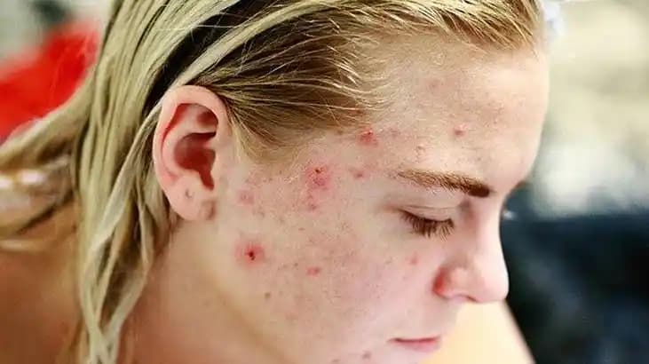 Büyük Sivilcelerin Nedenleri ve Cilt Sağlığını Koruma Yöntemleri