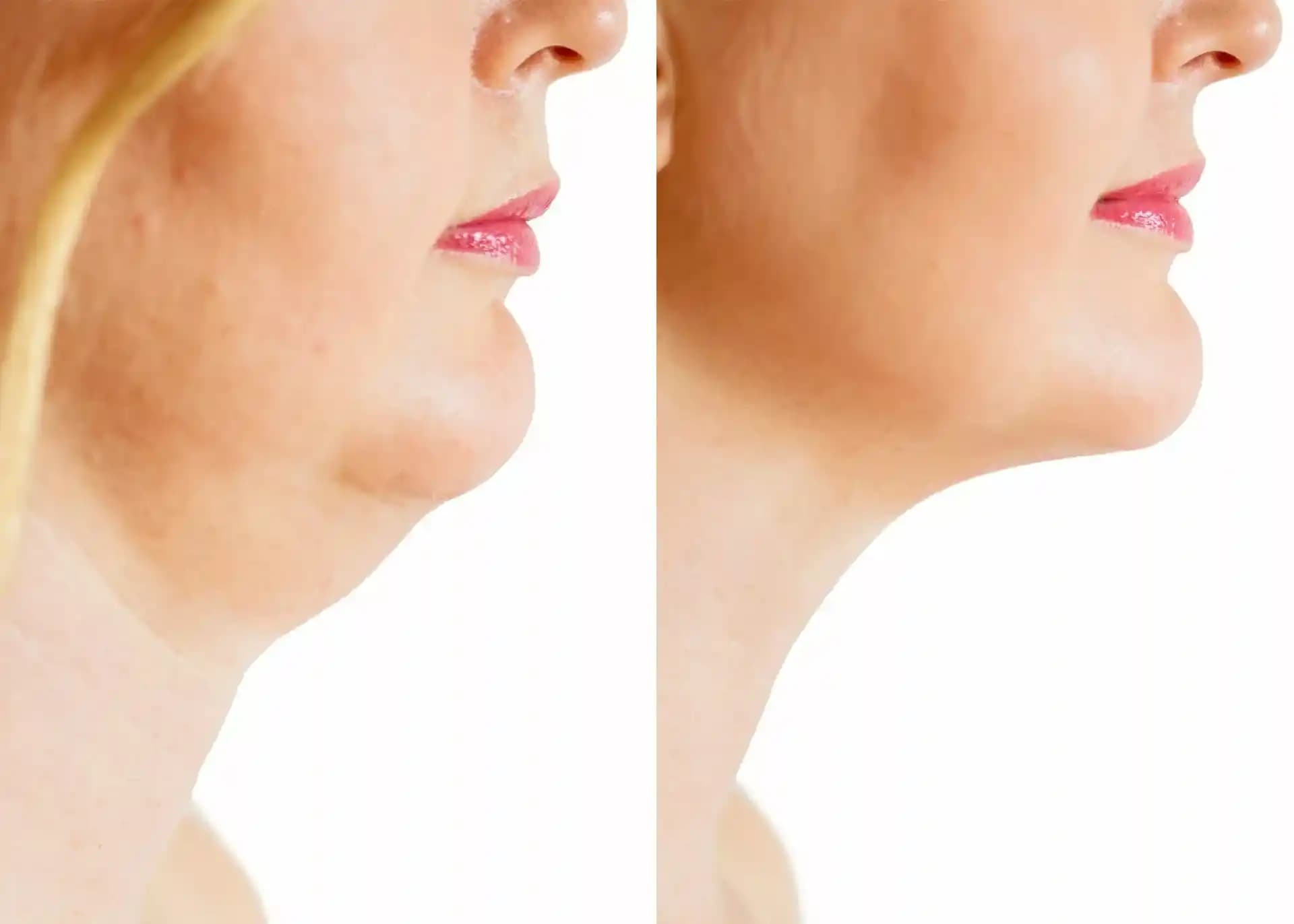 Buzla Gıdı Eritme Yöntemi: Non-invaziv Estetik Uygulamalar ve Avantajları