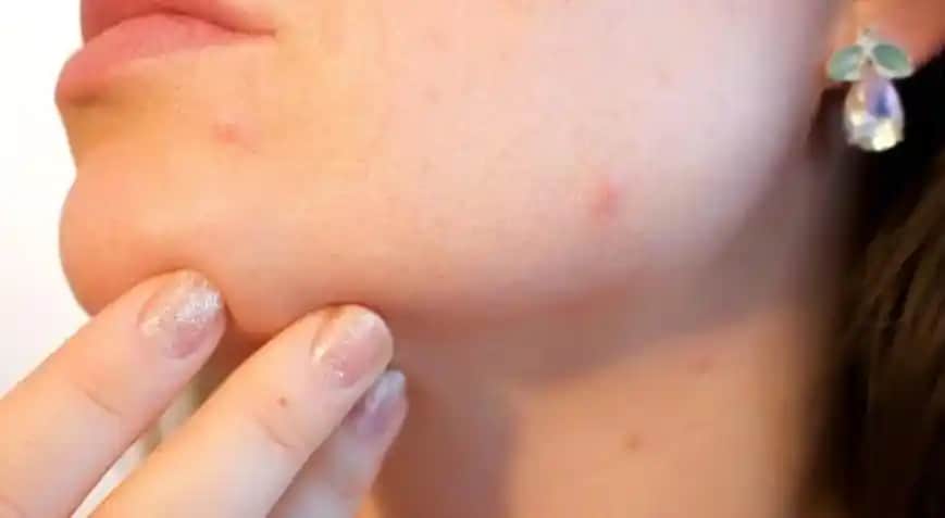 Çene Sivilceleri Nedenleri, Çözüm Yolları ve Kozmetik Yaklaşımlar