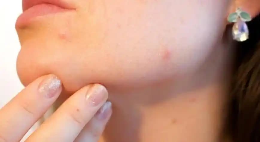 Çene Sivilceleri Nedenleri, Çözüm Yolları ve Kozmetik Yaklaşımlar