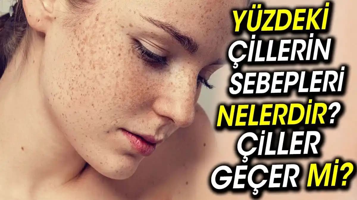 Çiller Geçer mi? Kozmetik Yaklaşımlar ve Doğal Çözüm Önerileri