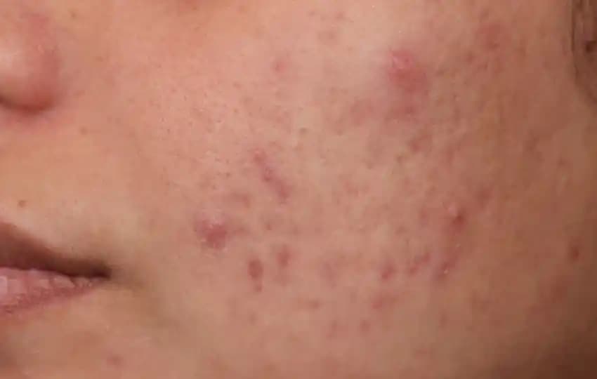 Cilt İrritasyonu Nedenleri Belirtileri ve Korunma Yöntemleri Kozmetik Ürünlerde