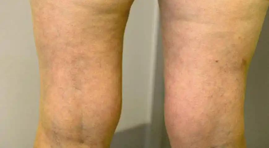 Cilt Renk Eşitsizliğiyle Mücadele Yöntemleri ve Doğal Çözümler