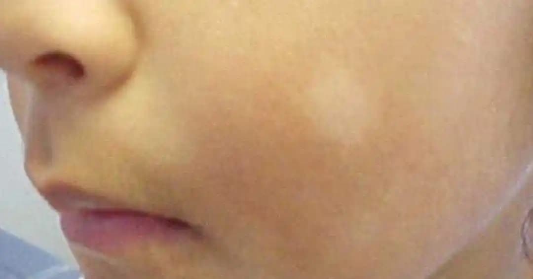 Ciltte Beyaz Nokta Nedir, Nedenleri ve Etkili Tedavi Yöntemleri Hakkında Bilgiler