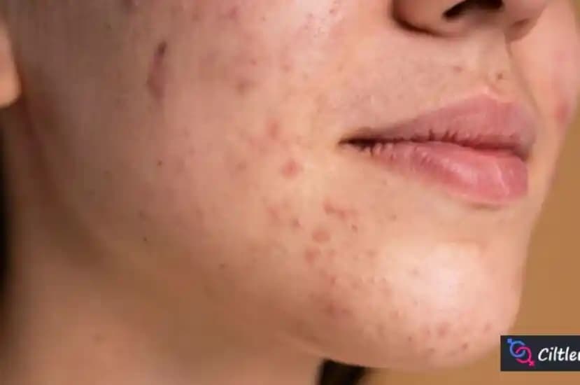 Ciltte Çıkan Yaraların Tedavisi ve Kozmetik ile Gizlenme Yöntemleri Rehberi