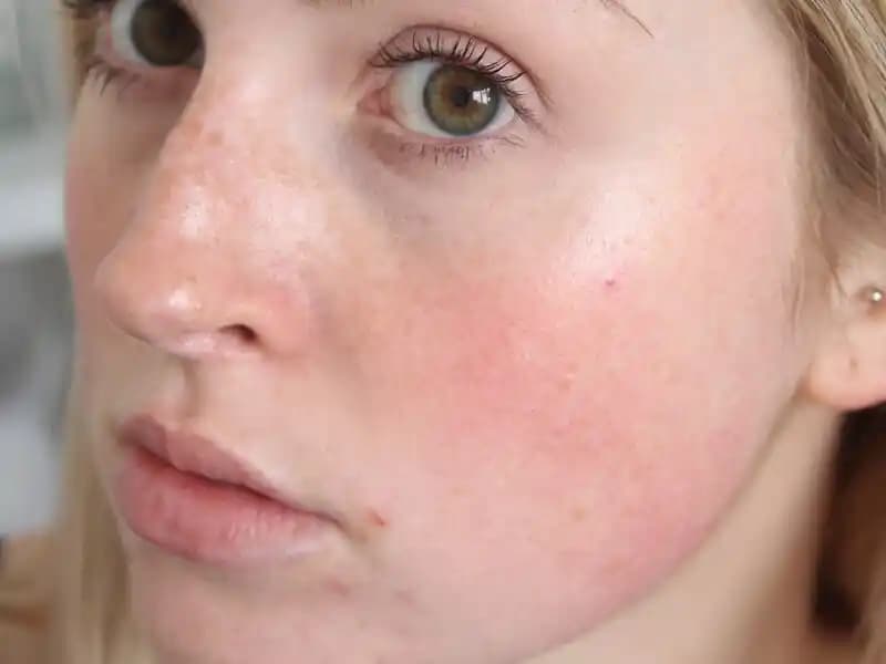 Ciltte Kırmızı Lekelerin Nedenleri ve Etkili Tedavi Yöntemleri Hakkında Detaylı Bilgi