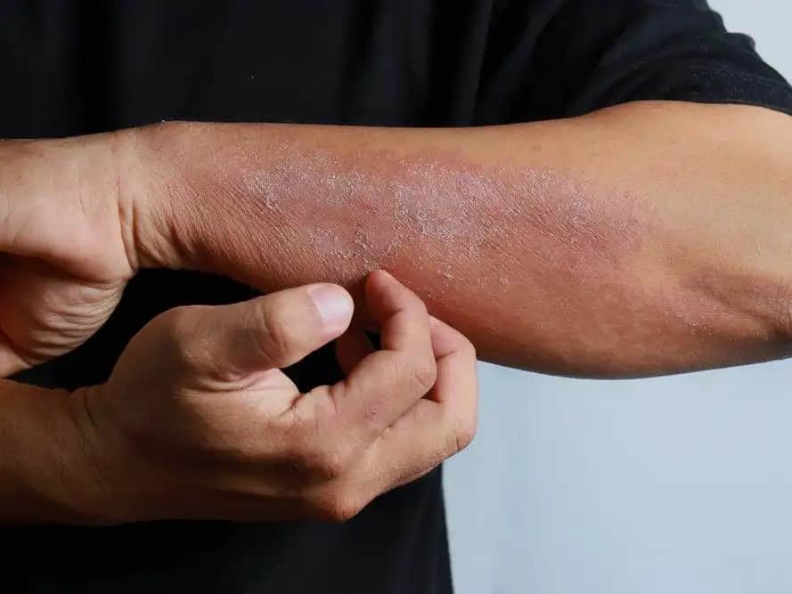 Ciltte Mantar Belirtileri ve Korunma Yöntemleri Hakkında Kapsamlı Bilgi