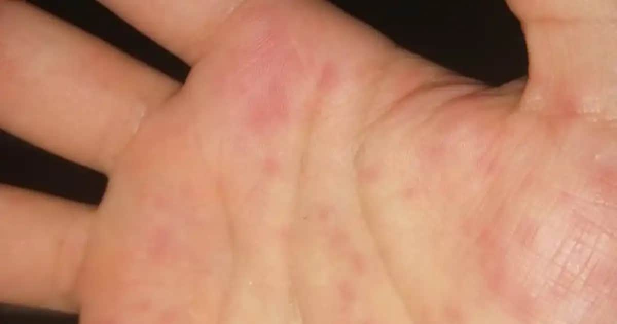 Ciltte Ortaya Çıkan Kırmızı Noktaların Nedenleri ve Etkili Bakım Yöntemleri