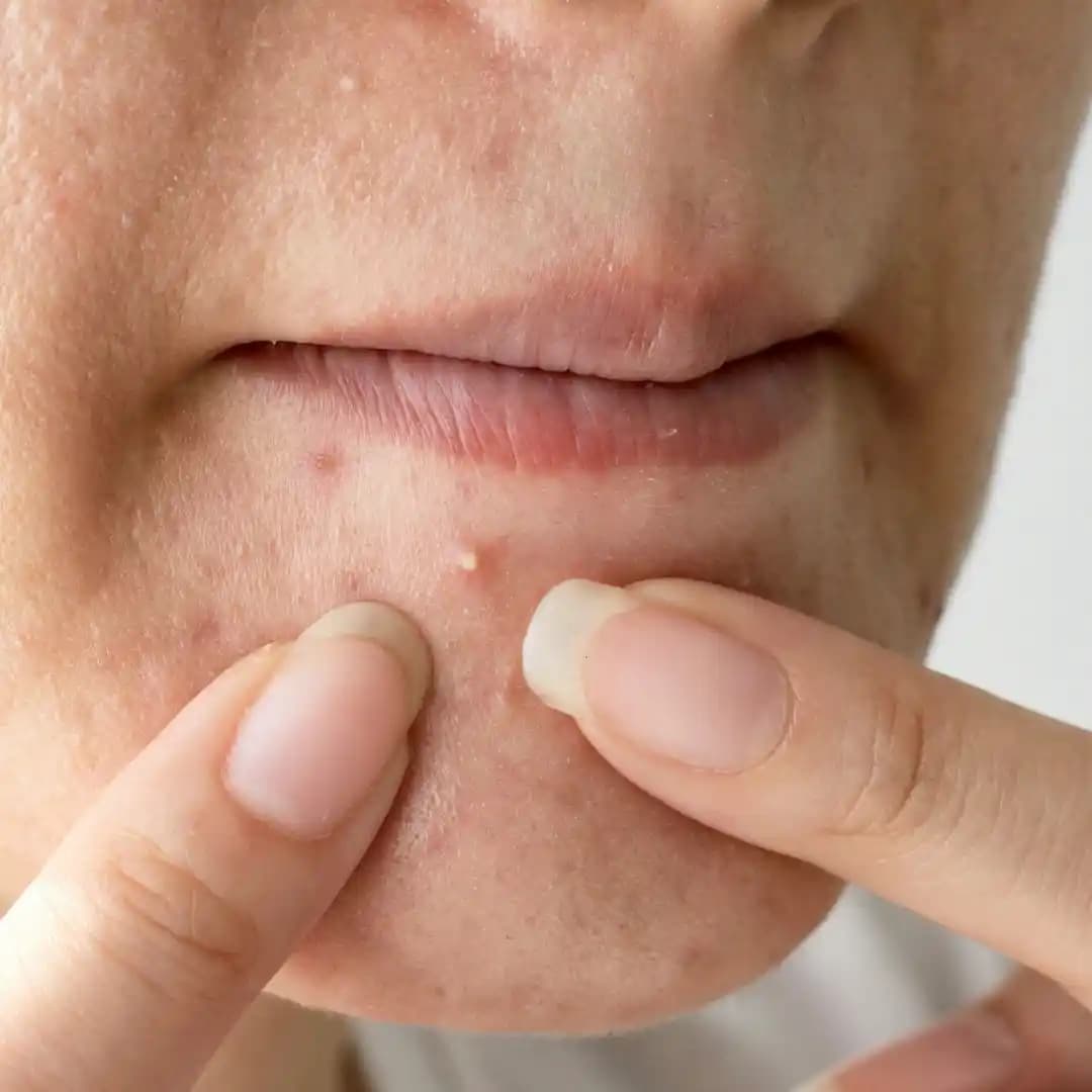 Ciltte Sivilce Nedenleri ve Etkili Çözüm Yöntemleri Hakkında Kapsamlı Bilgi