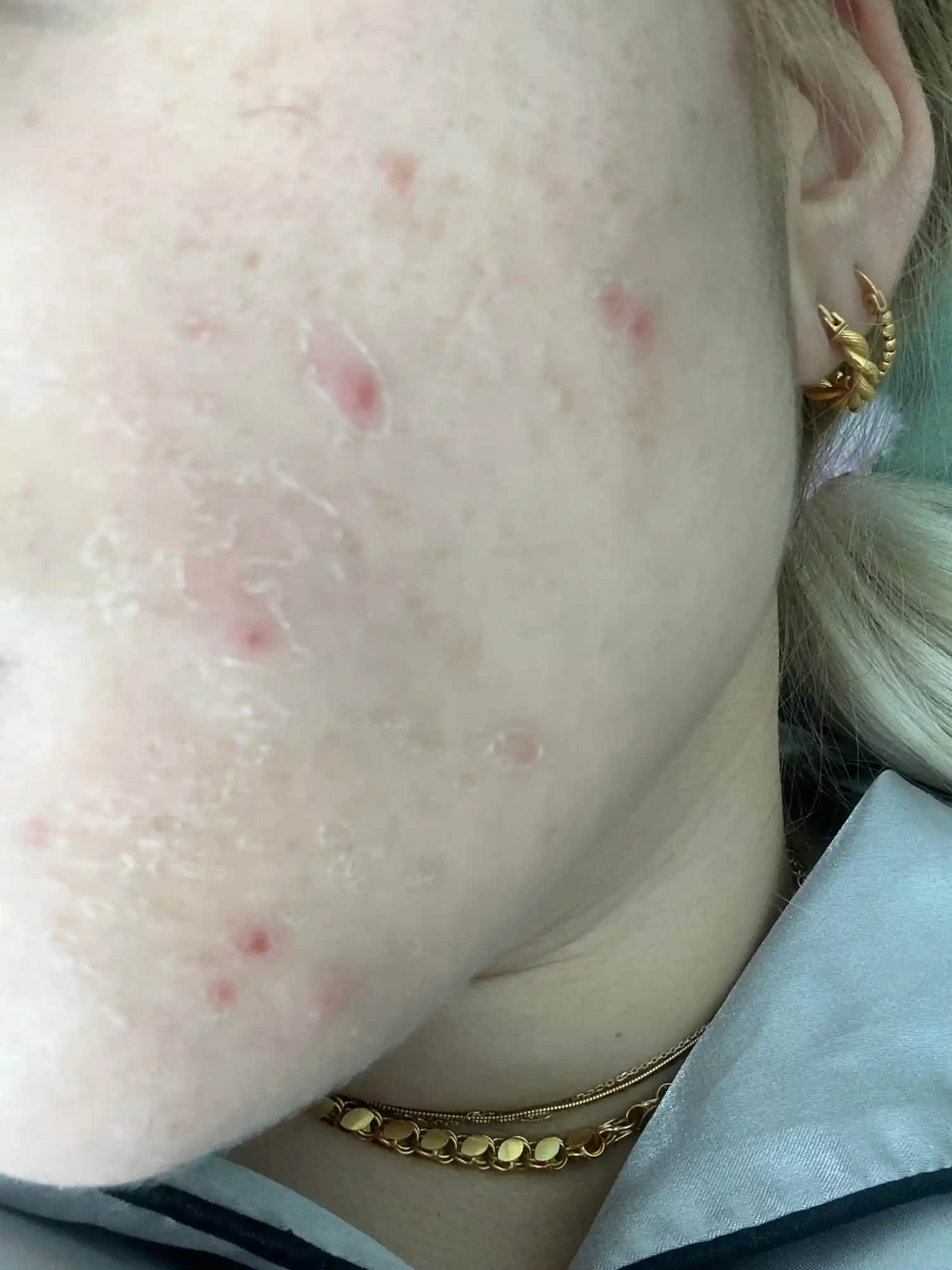 Ciltte Sivilce ve Benzeri Sorunlar: Doğru Bakım ve Ürün Seçimi Rehberi