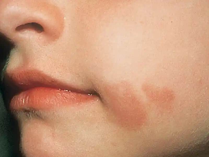 Ciltte Yanık Gibi Lekelerin Nedenleri ve Etkili Tedavi Yöntemleri