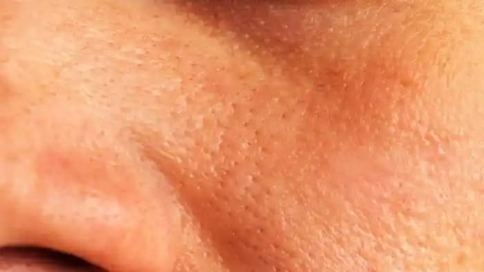 Ciltteki Gözenekleri Azaltma ve Sağlıklı Bir Cilt İçin Etkili Yöntemler