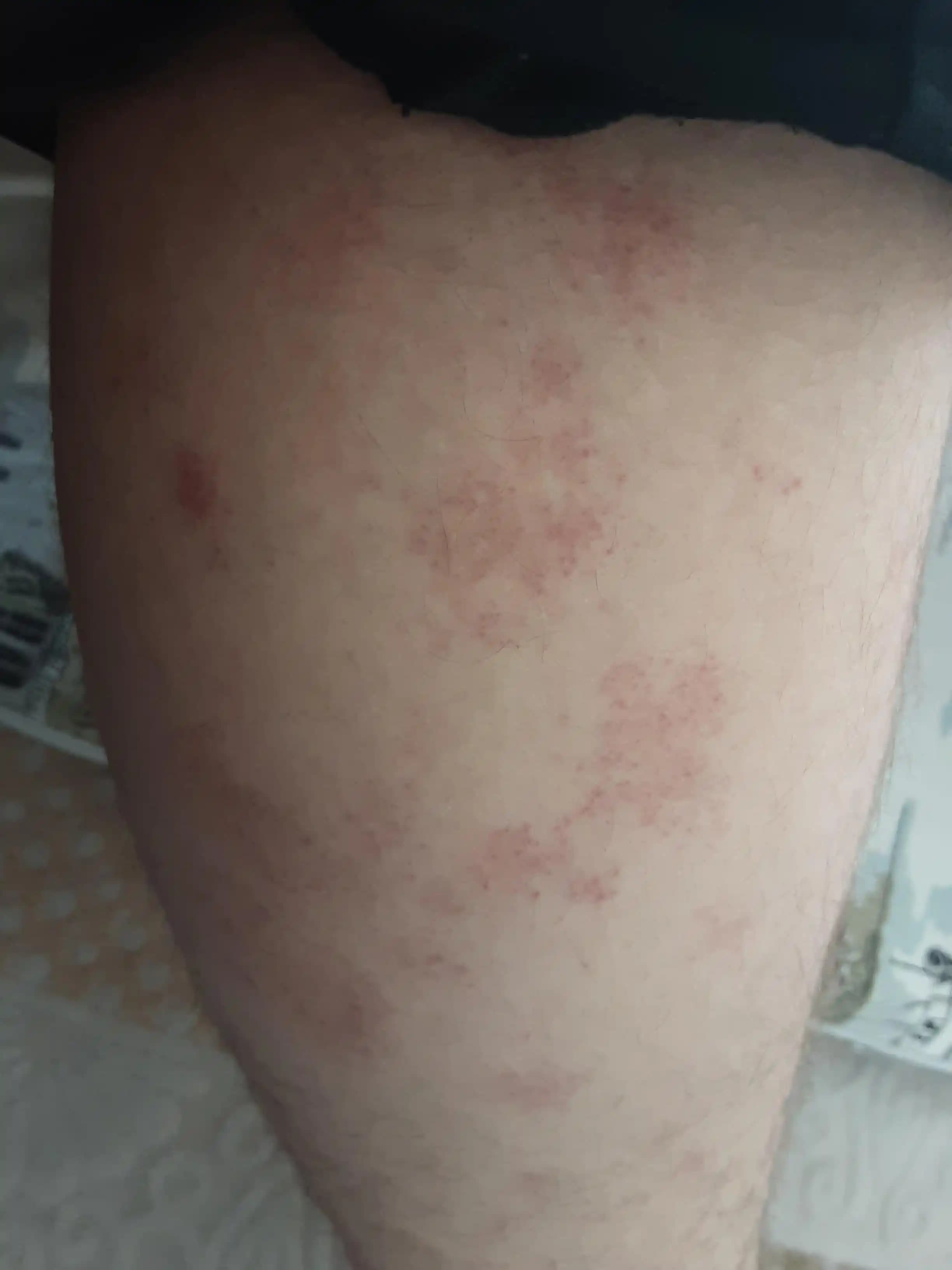 Ciltteki Kara Lekeler: Nedenleri, Çeşitleri ve Etkili Çözüm Yöntemleri