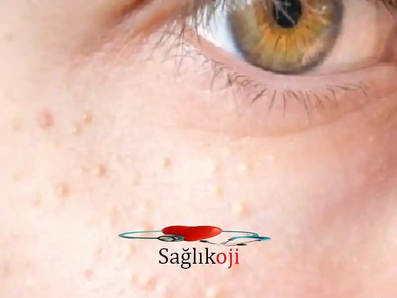 Ciltteki Küçük Kabarcıkların Nedenleri ve Etkili Tedavi Yöntemleri