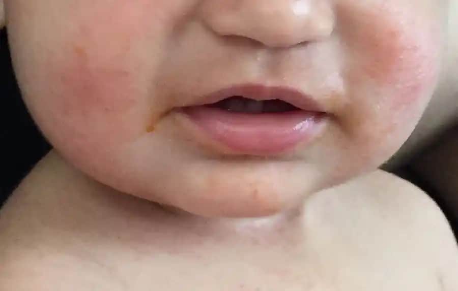 Çocuklarda Dermatitle Mücadele ve Cilt Sağlığını Koruma Yolları Analizi