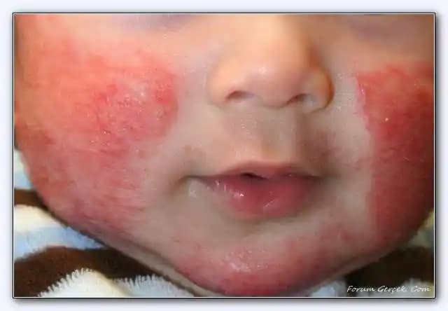 Çocuklarda Kafa Egzaması Nedenleri, Belirtileri ve Etkili Bakım Yöntemleri