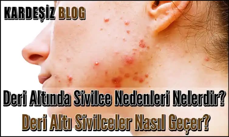 Deri İçinde Sivilce Nedenleri ve Etkili Bakım Yöntemleri Hakkında Kapsamlı Bilgi