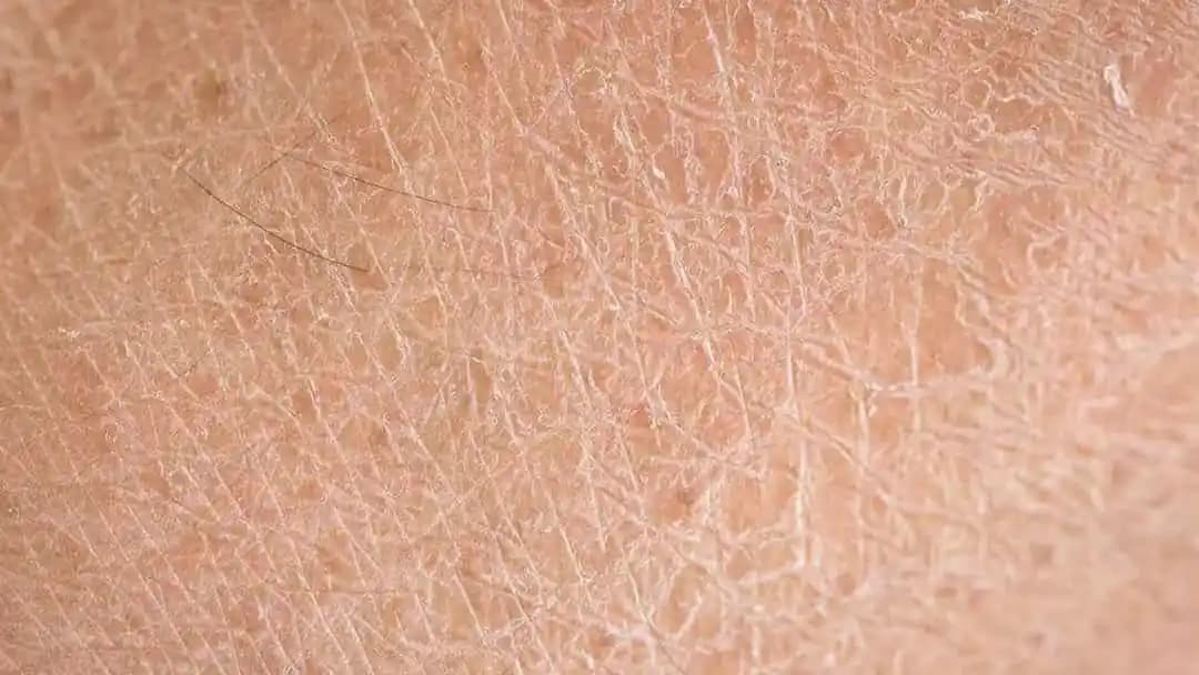 Deri Kuruluğunun Nedenleri, Belirtileri ve Etkili Tedavi Yöntemleri