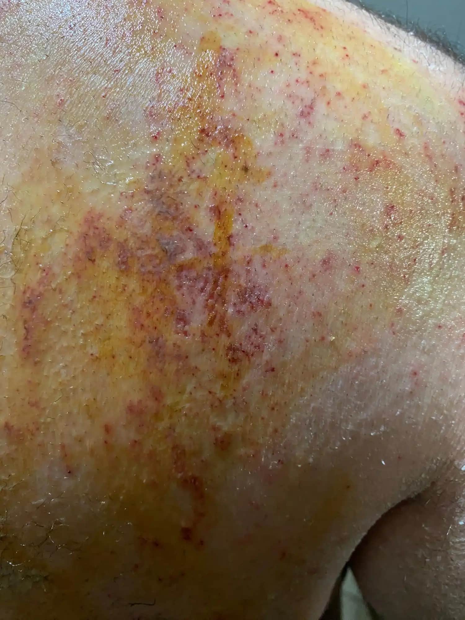 Deri Tahrişi ve Korunma Yöntemleri: Cilt Sağlığını Korumanın En İyi Yolları