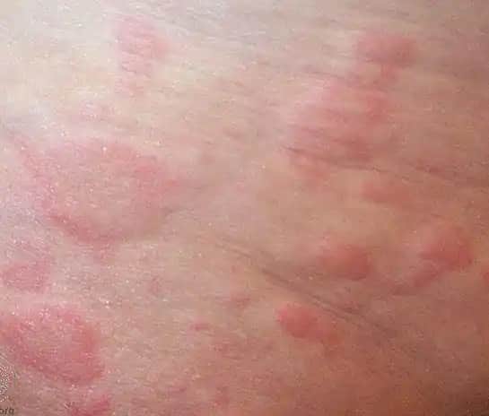 Deride Kızarıklık ve Kozmetik Çözüm Yöntemleri: Cilt Bakımında Etkili Yaklaşımlar