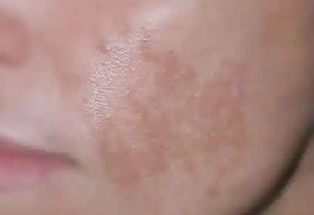 Deride Leke Türleri ve Etkili Tedavi Yöntemleri Hakkında Kapsamlı Bilgiler