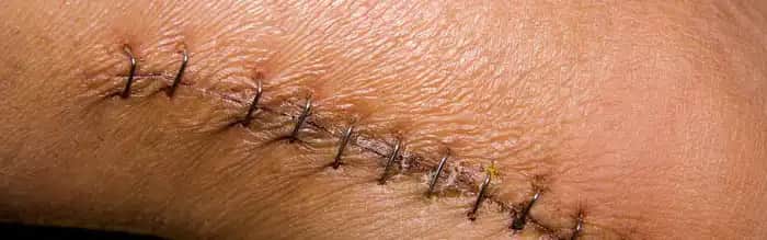 Dikiş Gerektiren Yaraların Bakımı ve Estetik Çözümlerle Gelişmiş İyileşme Süreci