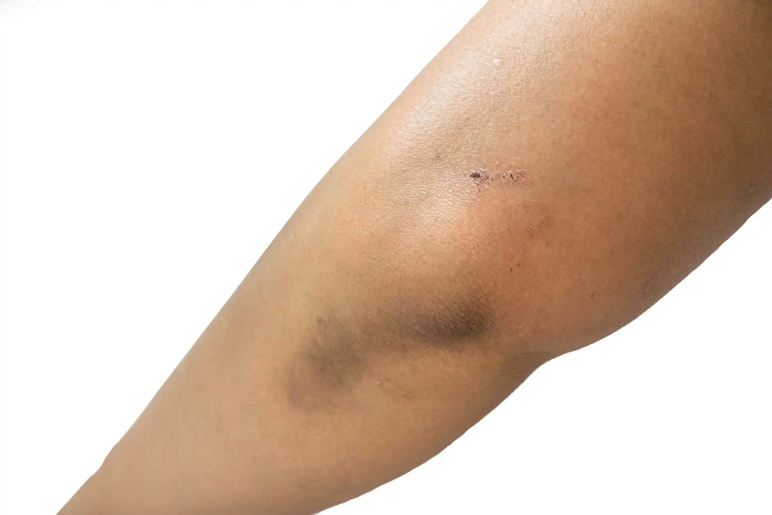 Dirsek Kararmasının Nedenleri ve Korunma Yöntemleri Hakkında Detaylı Bilgi