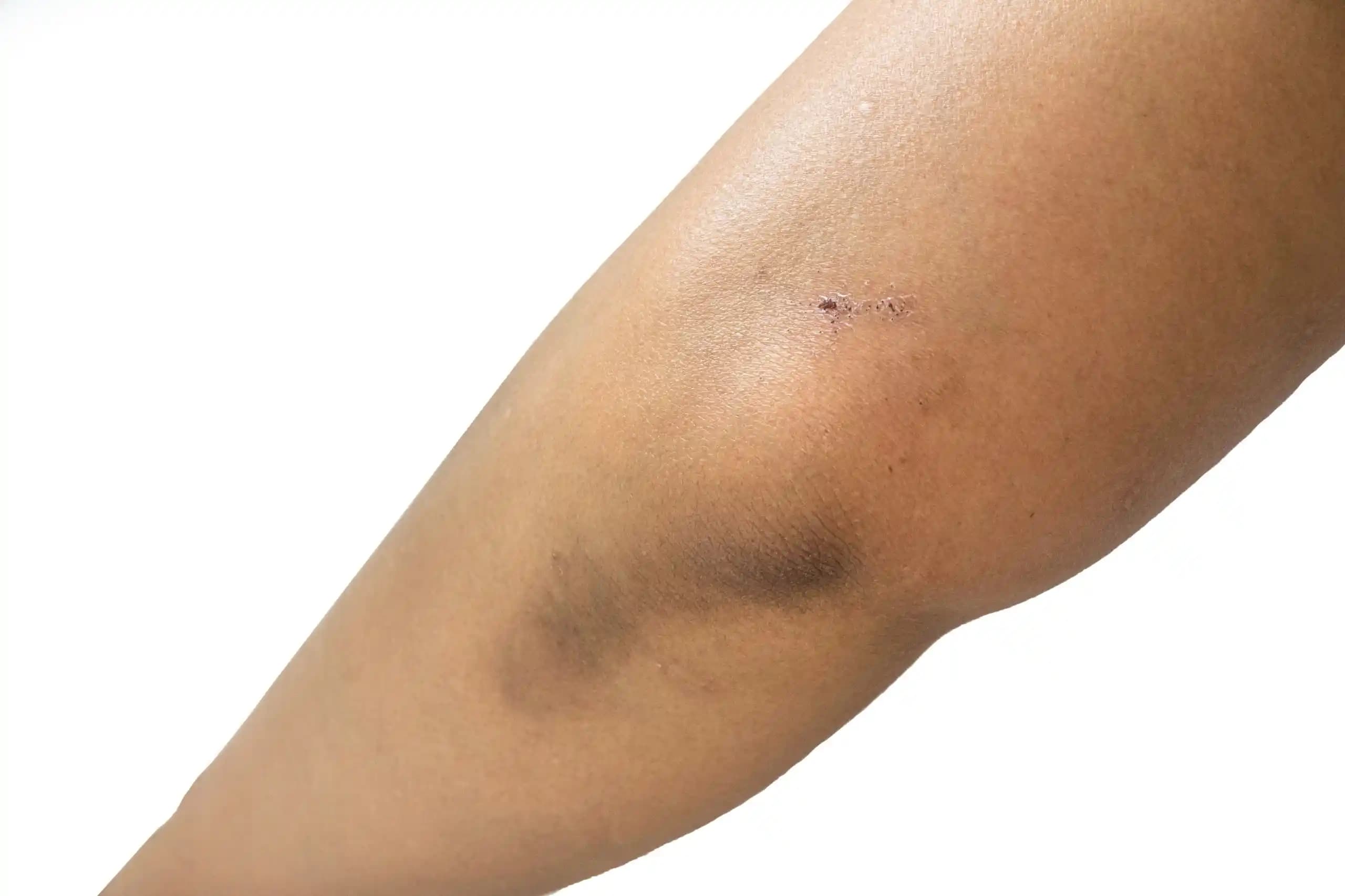 Dirsek Kararmasının Nedenleri ve Korunma Yöntemleri Hakkında Detaylı Bilgi