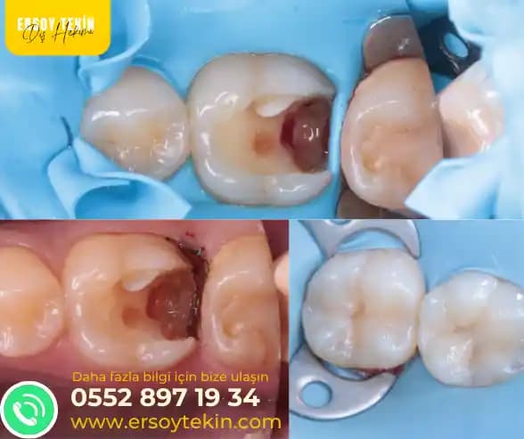 Diş Dolgusu Fiyatları 2024 Güncel Bilgiler ve Uzman Tavsiyeleri