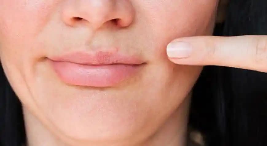 Diş Macunu ve Sivilceler: Gerçekler ve Yanlış Bilinenler Hakkında Bilmeniz Gerekenler