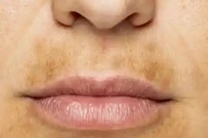 Dudak Lekeleri Nedenleri, Önlemleri ve Çözüm Yolları Rehberi
