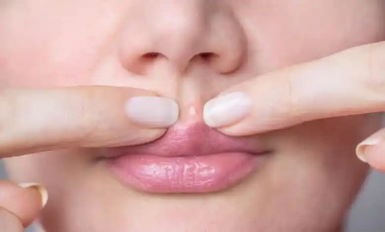 Dudak Yanında Sivilce Nedenleri, Belirtileri ve Etkili Doğal Çözüm Yöntemleri