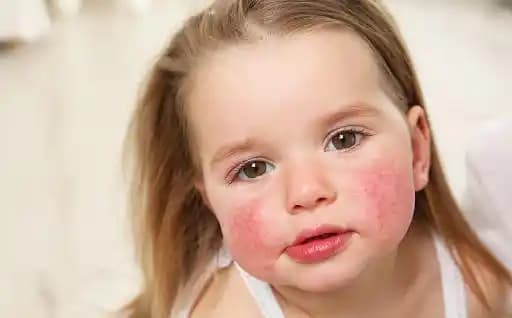 Duştan Sonra Yüz Kızarması Nedenleri ve Etkili Çözüm Yolları