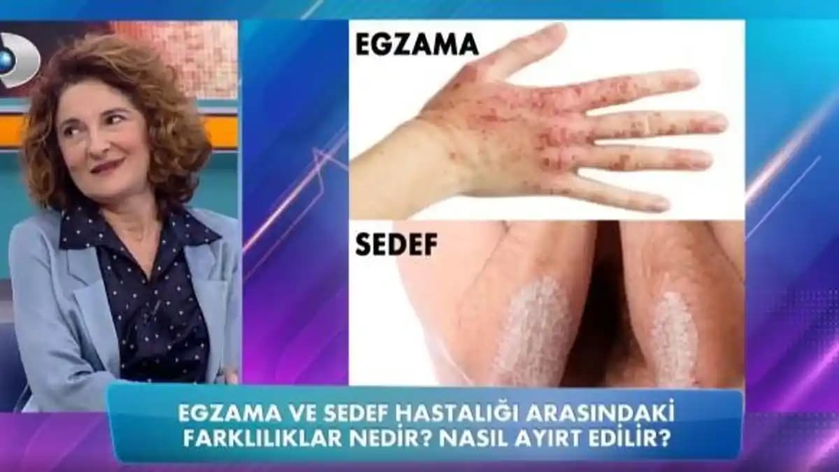 Egzama ile Sedef Hastalığı Arasındaki Temel Farklar ve Tedavi Yöntemleri