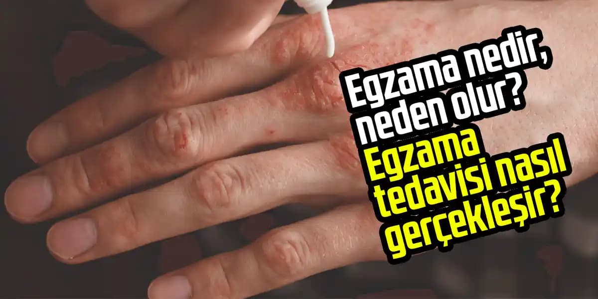 Egzama Nedir, Belirtileri ve Etkili Tedavi Yöntemleri Hakkında Detaylı Rehber