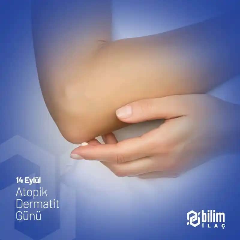 Egzama Nedir, Belirtileri ve Güncel Tedavi Yöntemleri Hakkında Bilgiler