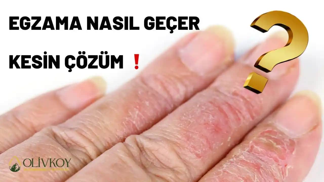 Egzama Tedavisinde Zeytinyağının Etkileri ve Kullanım Yöntemleri Hakkında Detaylı Bilgi