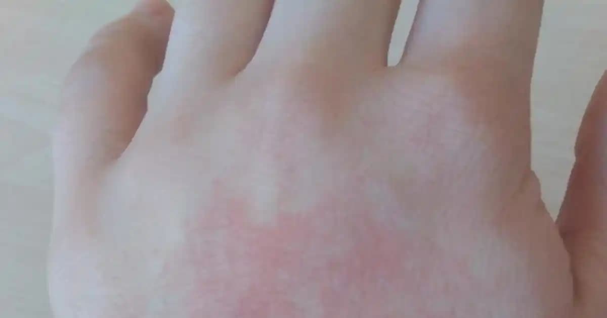 El Üzerindeki Kızarıklıkların Nedenleri ve Etkili Hafifletici Yöntemler