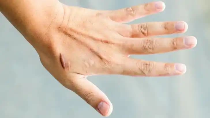 El Yaralarının Hızlı İyileşmesi İçin Etkili Yöntemler ve Bakım İpuçları